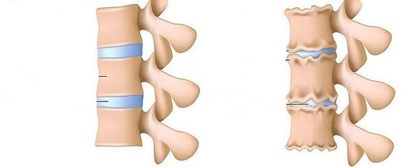 o coloană vertebrală sănătoasă și osteocondroză