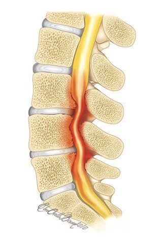 Cu osteocondroza coloanei vertebrale toracice, are loc compresia canalului spinal
