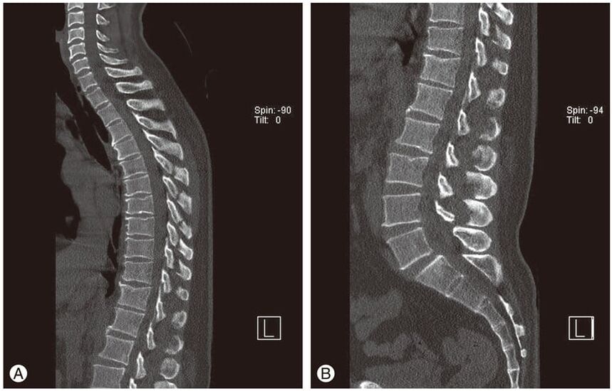 Deformarea discurilor intervertebrale pe imagini RMN în osteocondroza toracică