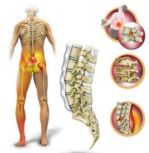 Osteocondroza coloanei lombare, provocând dureri de spate