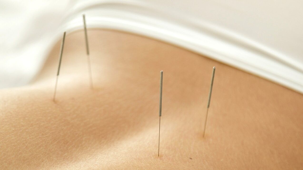 Acupunctura vă va ajuta să scăpați de durerile de spate