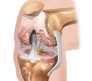 Cartilajului de la genunchi